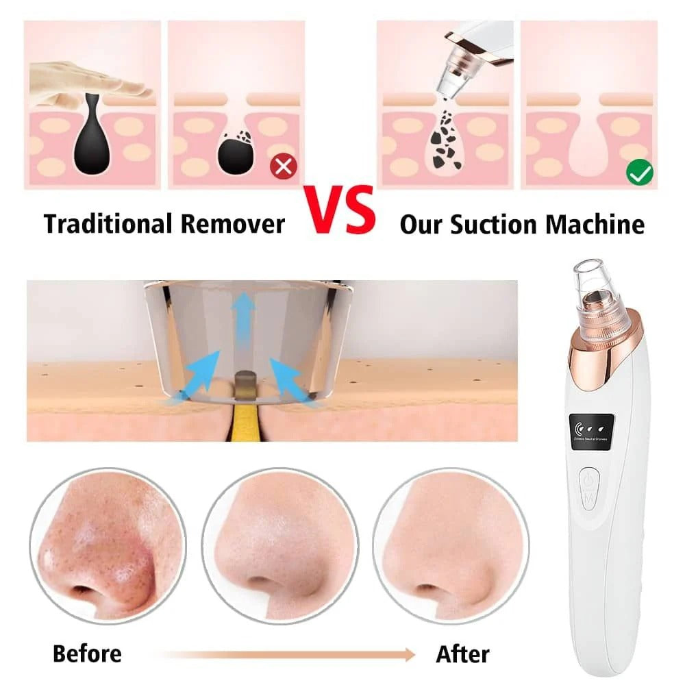 Digital Blackhead Remover